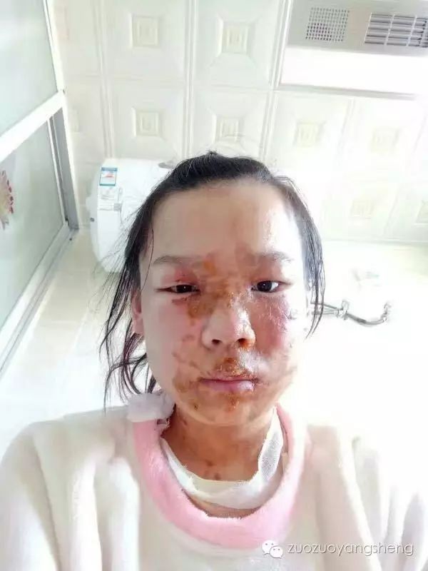案例分享:原始点调理花季少女面部烫伤不留疤的案例 案例分享:原始点调理花季少女面部烫伤不留疤的案例