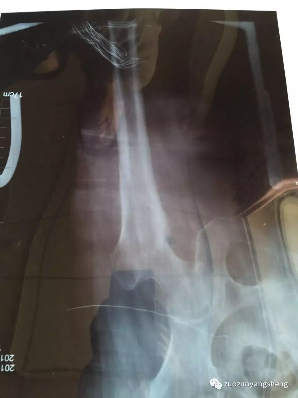 原始点续写又一奇迹：83岁婆婆骨折错位没开刀没手术，6周康复