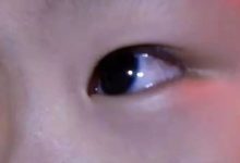 案例分享:原始点调理四岁小孩角膜炎案例-原始点全球同学网