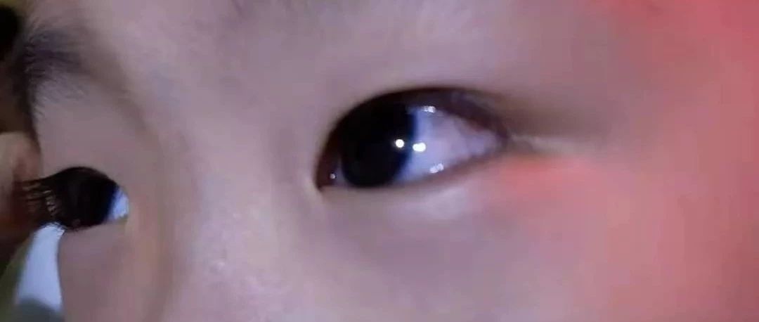 案例分享：原始点调理四岁小孩角膜炎案例-原始点全球同学网