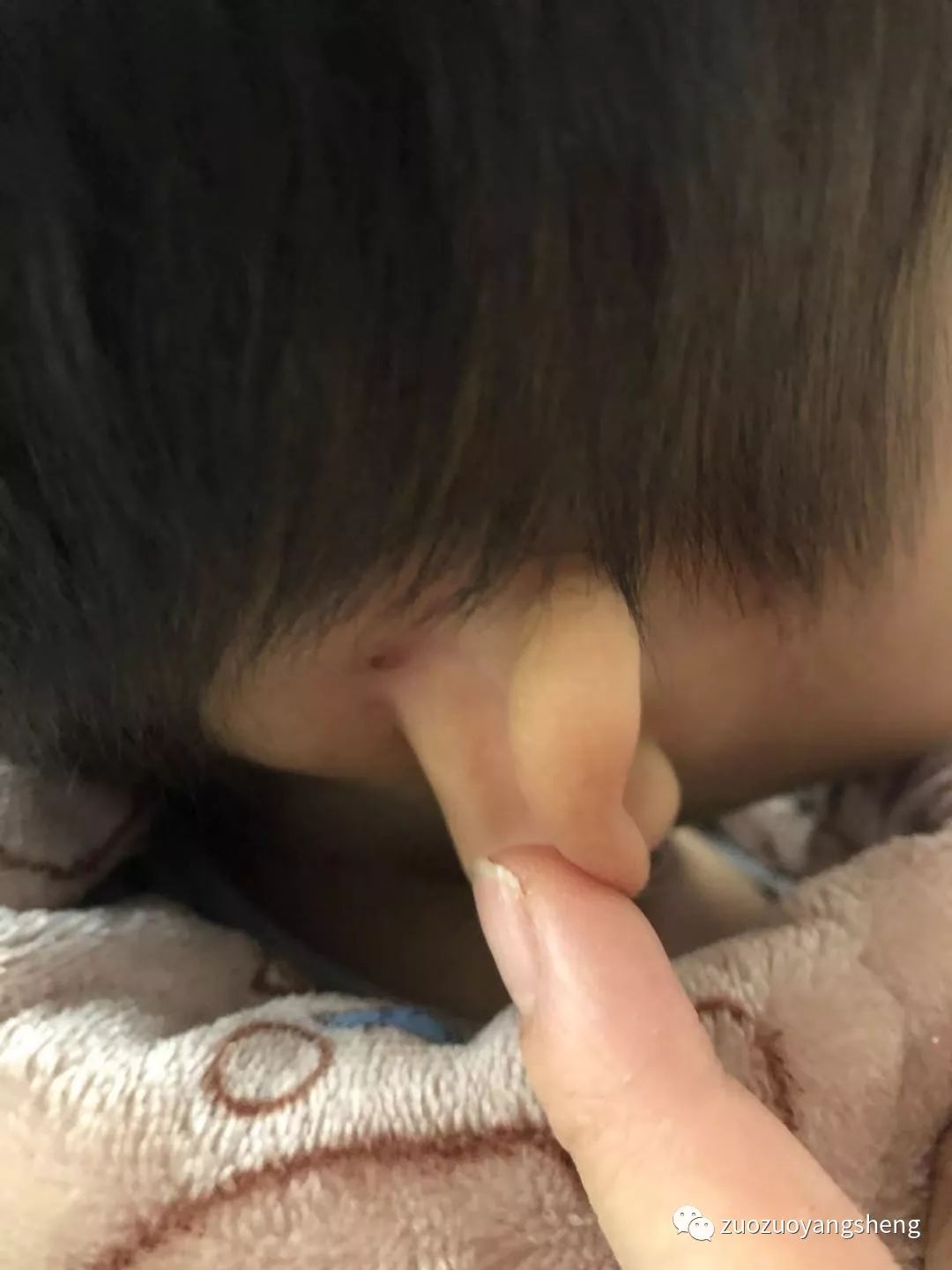 案例分享:原始点调理五岁小孩长水痘案例 案例分享:原始点调理五岁小孩长水痘案例