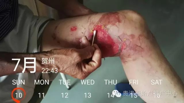 案例分享:原始点调理车祸烧伤不留疤的案例 案例分享:原始点调理车祸烧伤不留疤的案例