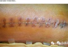 案例分享：原始点调理骨折手术后的恢复-原始点全球同学网