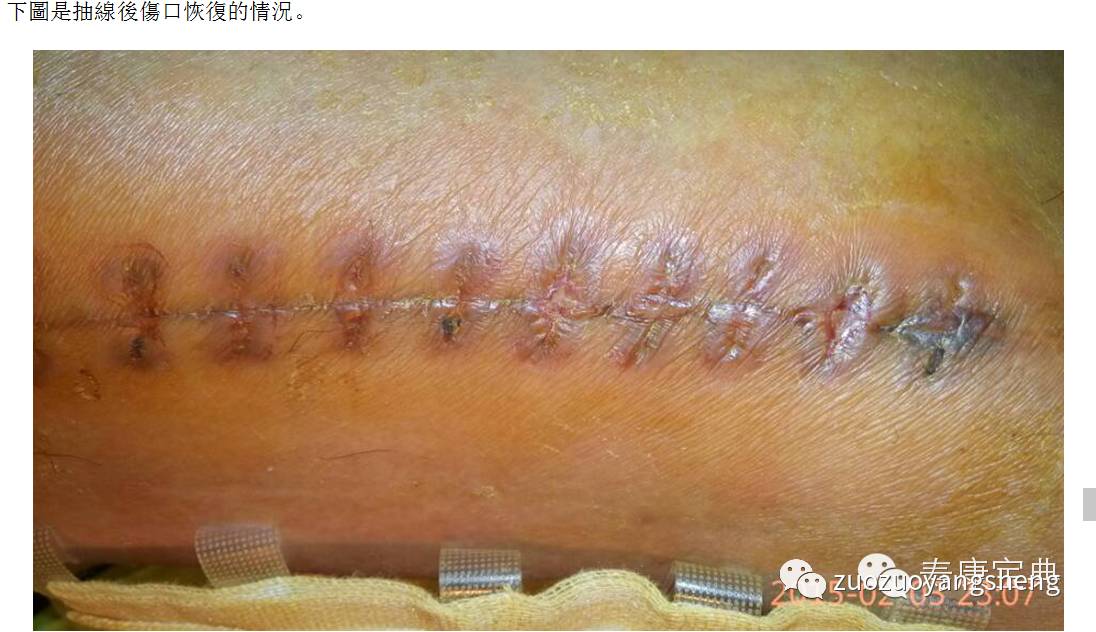 案例分享：原始点调理骨折手术后的恢复-原始点全球同学网