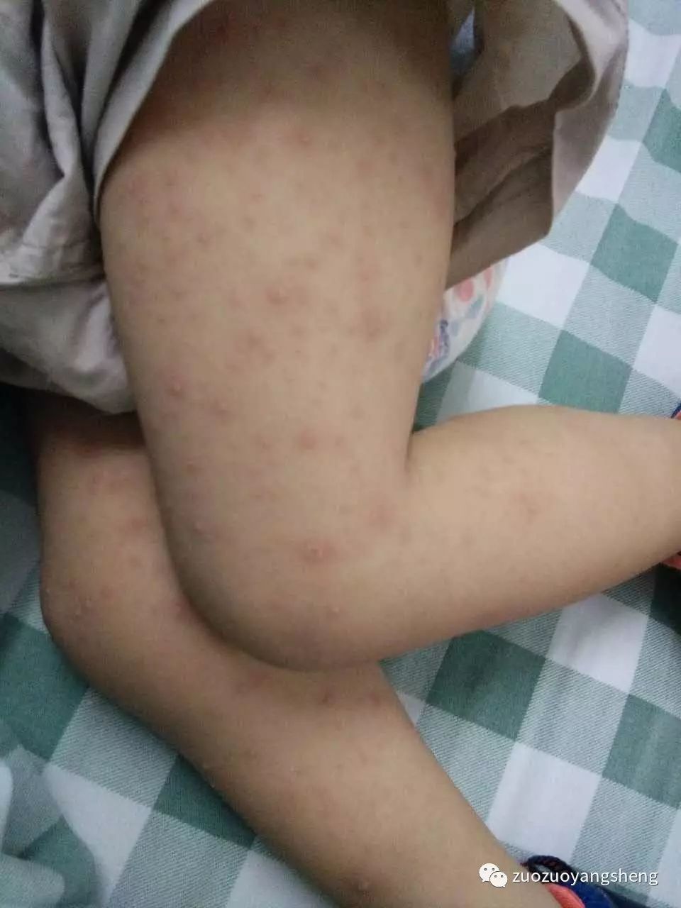 原始点调理幼儿咳嗽后出现严重好转反应