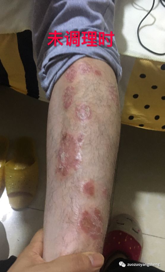 案例分享:原始点调理十几年牛皮癣的案例 案例分享:原始点调理十几年牛皮癣的案例