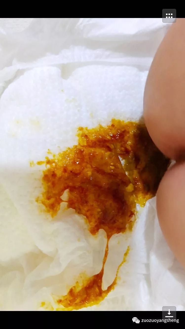 案例分享:原始点调理三个月宝宝腹泻、便血的案例 案例分享:原始点调理三个月宝宝腹泻、便血的案例