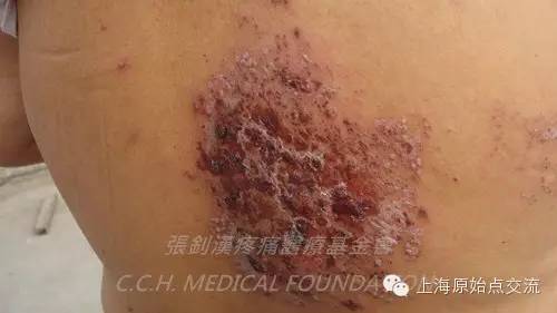 案例分享:原始点调理带状疱疹的案例 案例分享:原始点调理带状疱疹的案例