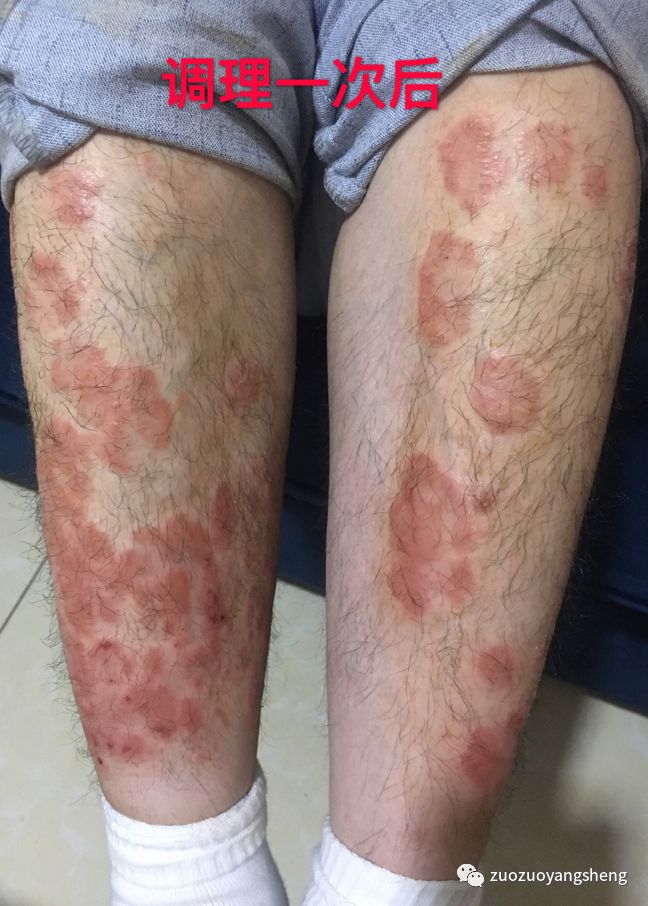 案例分享:原始点调理十几年牛皮癣的案例 案例分享:原始点调理十几年牛皮癣的案例