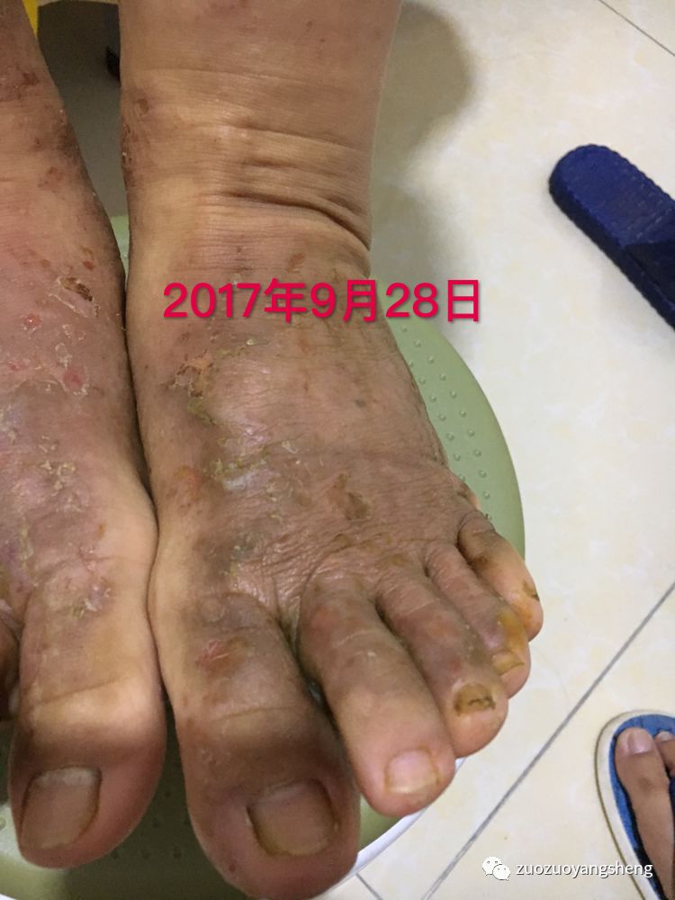 案例分享:原始点调理全身奇痒无比的湿疹案例 案例分享:原始点调理全身奇痒无比的湿疹案例