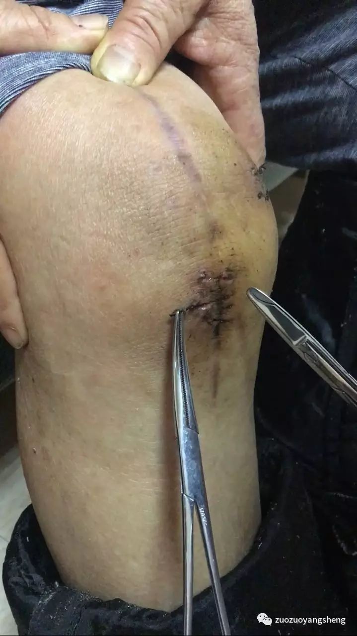 案例分享:最难度的家人——原始点调理妈妈骨折手术后的康复 案例分享:最难度的家人——原始点调理妈妈骨折手术后的康复