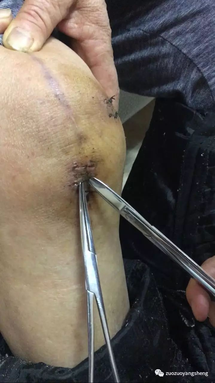 案例分享:最难度的家人——原始点调理妈妈骨折手术后的康复 案例分享:最难度的家人——原始点调理妈妈骨折手术后的康复