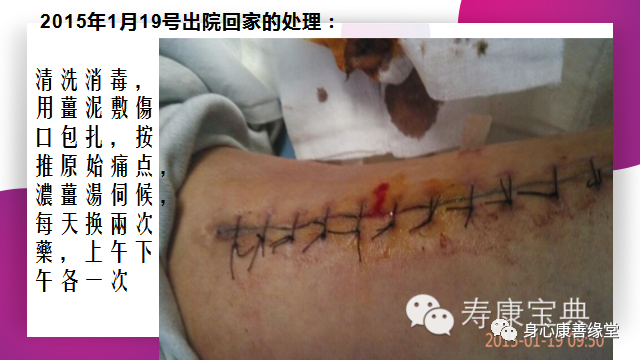 原始點:腿伤术后康复记 原始點:腿伤术后康复记