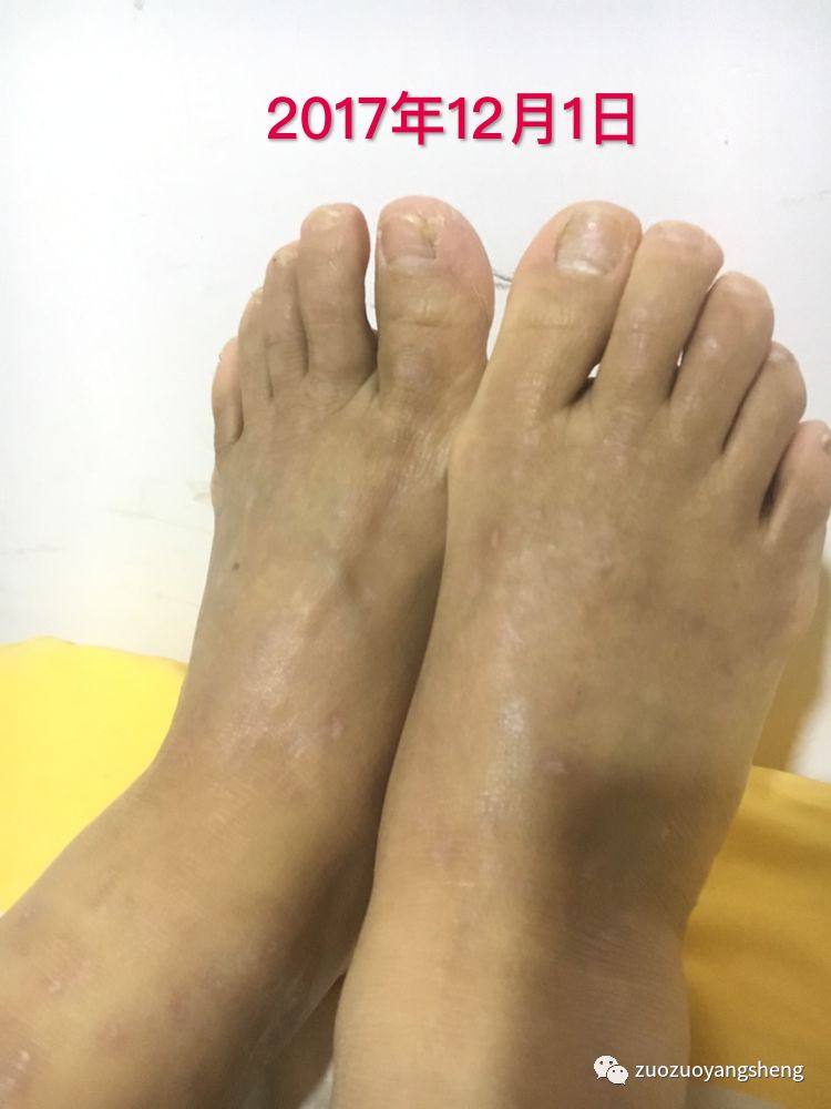 案例分享:原始点调理全身奇痒无比的湿疹案例 案例分享:原始点调理全身奇痒无比的湿疹案例