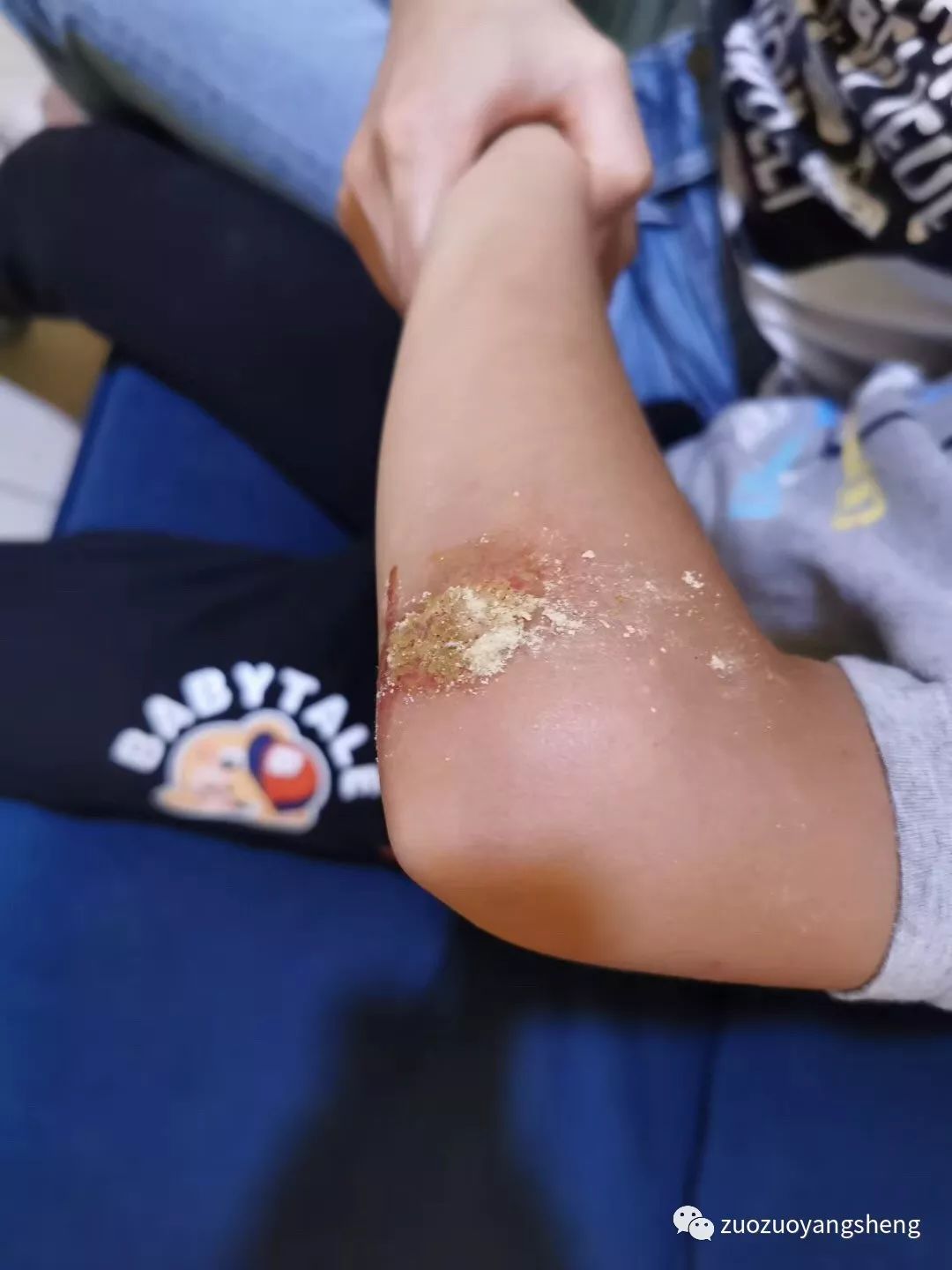 案例分享：原始点调理四岁小孩角膜炎案例