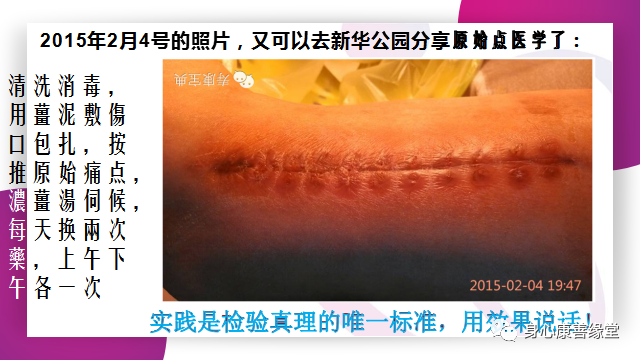 原始點:腿伤术后康复记 原始點:腿伤术后康复记