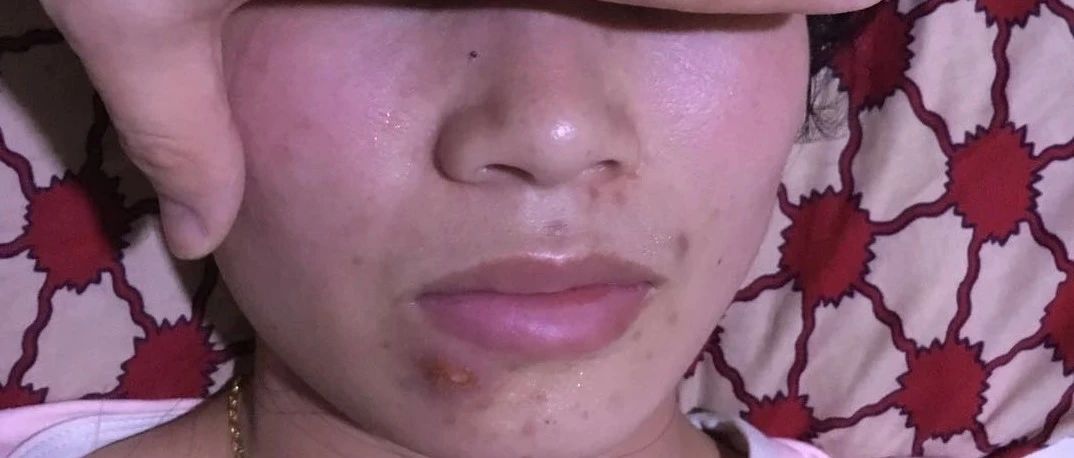 案例分享：原始点调理下巴长痘，咬肌发炎肿大的案例-原始点全球同学网