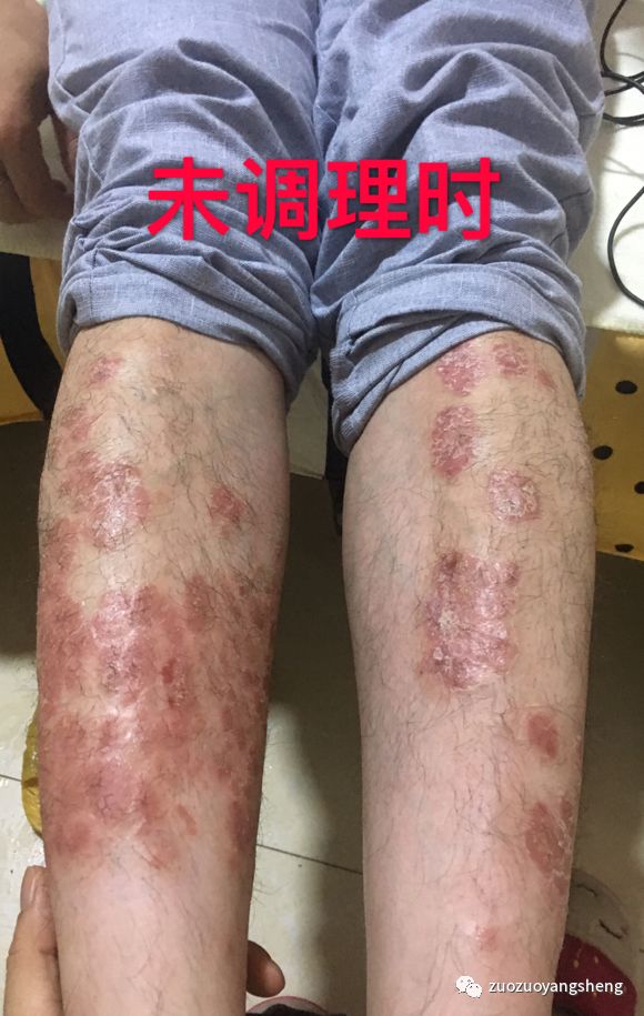 案例分享:原始点调理十几年牛皮癣的案例 案例分享:原始点调理十几年牛皮癣的案例