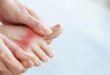 微问答180期:我表哥痛风三年了,一直药物控制,总是不能断根……-原始点全球同学网