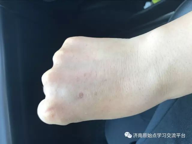 案例分享:巨痒湿疹案例 案例分享:巨痒湿疹案例