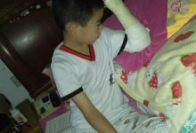 案例分享:原始点应用到骨折后的康复-原始点全球同学网