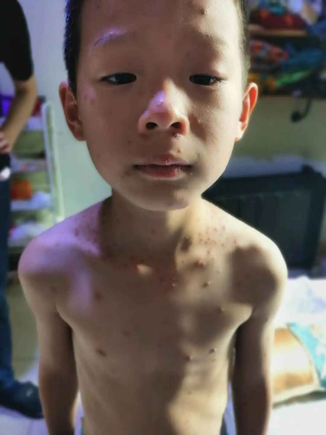 案例分享:原始点调理孩子水痘案例 案例分享:原始点调理孩子水痘案例