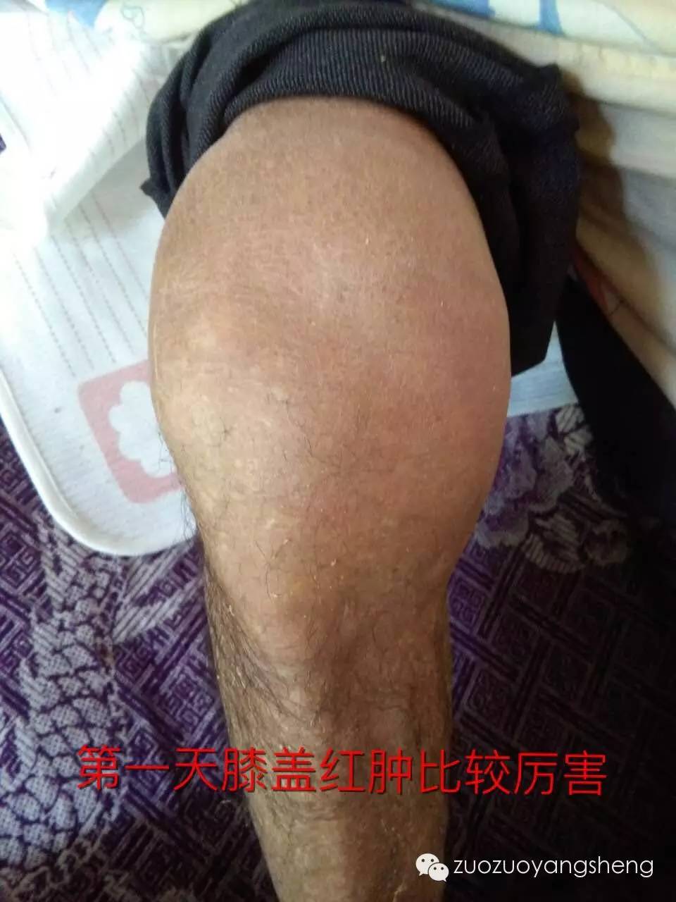 案例分享：原始点调理类风湿五天改善的案例