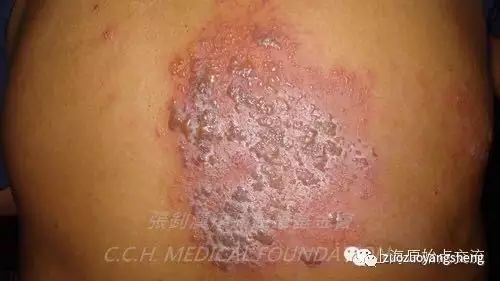 案例分享：原始点调理带状疱疹的案例-原始点全球同学网