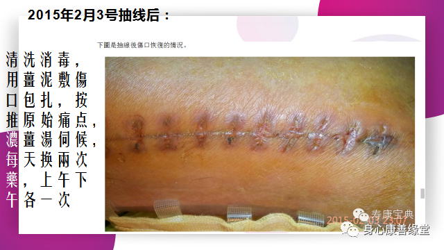 原始點:腿伤术后康复记 原始點:腿伤术后康复记