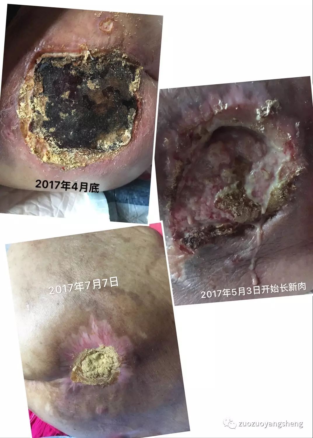 案例分享：原始点调理病危老人的案例