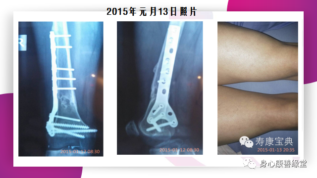 原始點:腿伤术后康复记 原始點:腿伤术后康复记