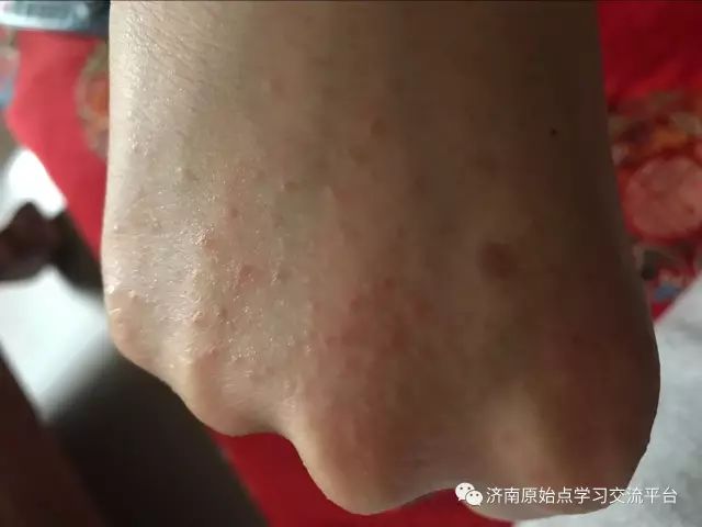 案例分享:巨痒湿疹案例 案例分享:巨痒湿疹案例