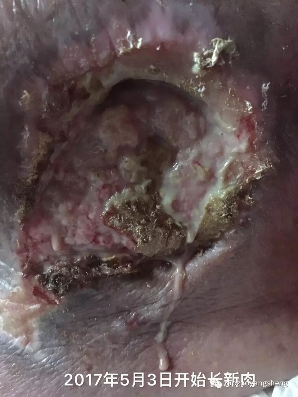 案例分享：原始点调理病危老人的案例