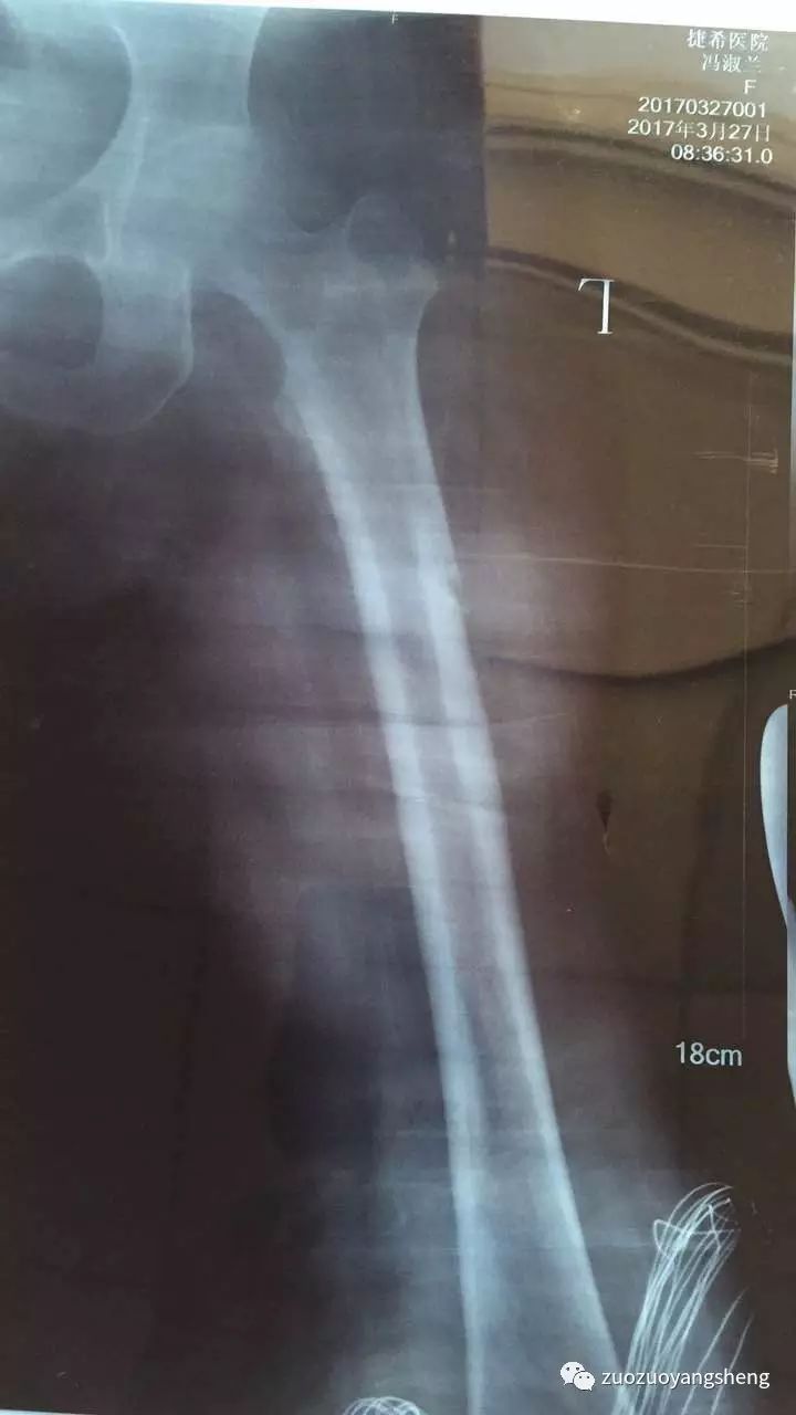 原始点续写又一奇迹:83岁婆婆骨折错位没开刀没手术,6周康复 原始点续写又一奇迹:83岁婆婆骨折错位没开刀没手术,6周康复