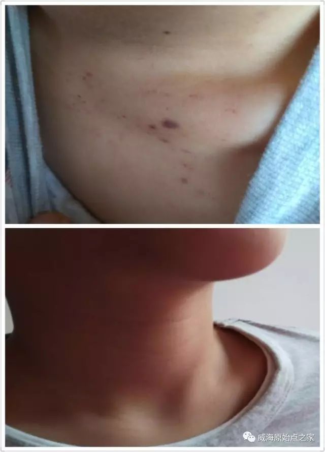 案例分享：原始点调理血小板减少症的案例