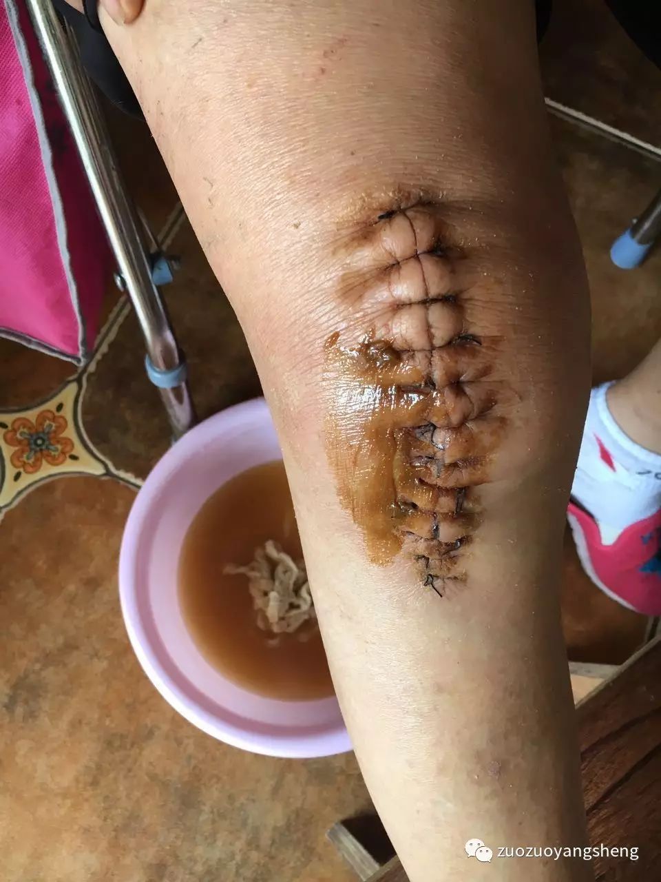 案例分享:最难度的家人——原始点调理妈妈骨折手术后的康复 案例分享:最难度的家人——原始点调理妈妈骨折手术后的康复