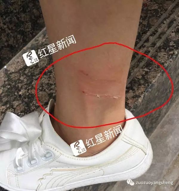 女子被狗咬28天后死 丈夫:为何打了狂犬疫苗也没用?如果学了原始点…… 女子被狗咬28天后死 丈夫:为何打了狂犬疫苗也没用?如果学了原始点……