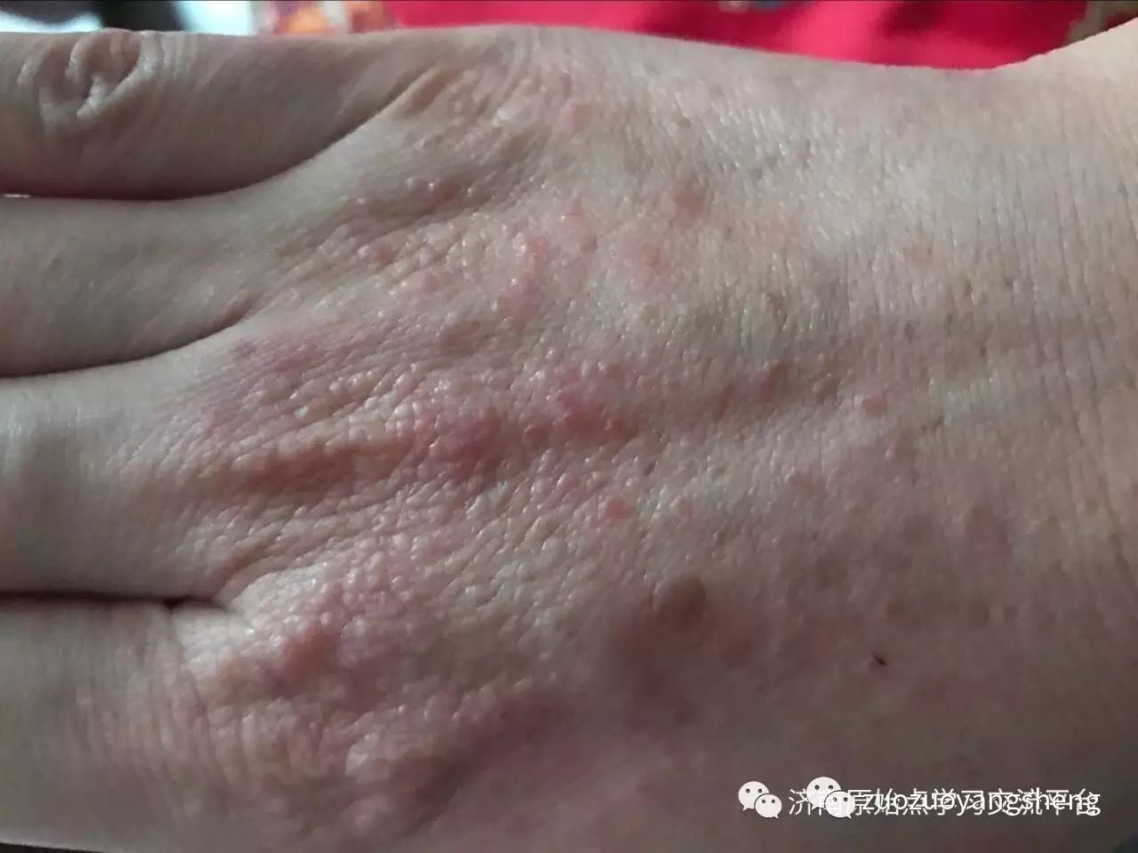 案例分享：巨痒湿疹案例-原始点全球同学网