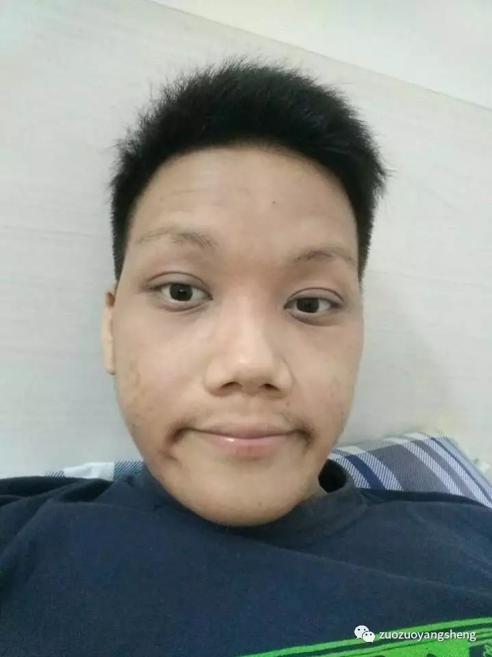 案例分享:马来西亚男孩严重湿疹,10天大变样 案例分享:马来西亚男孩严重湿疹,10天大变样