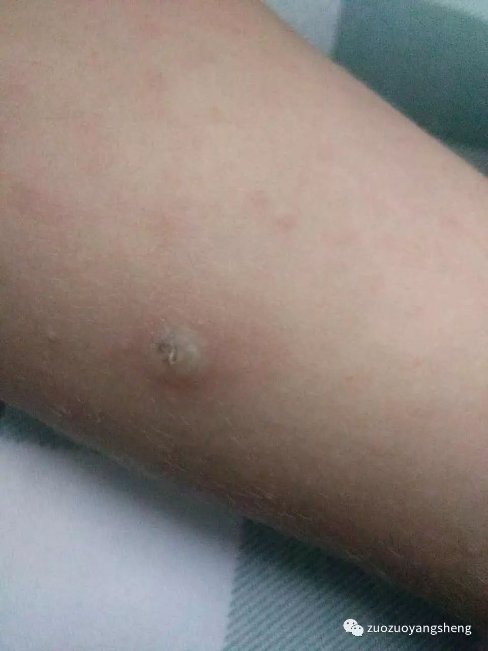 原始点调理幼儿咳嗽后出现严重好转反应