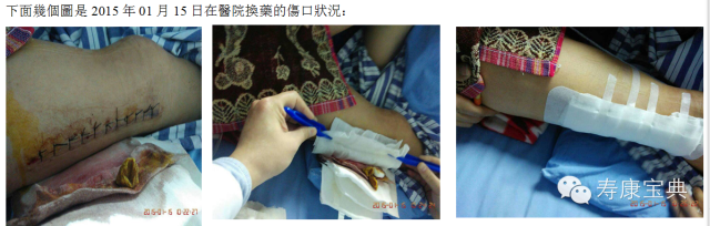 案例分享:原始点调理骨折手术后的恢复 案例分享:原始点调理骨折手术后的恢复