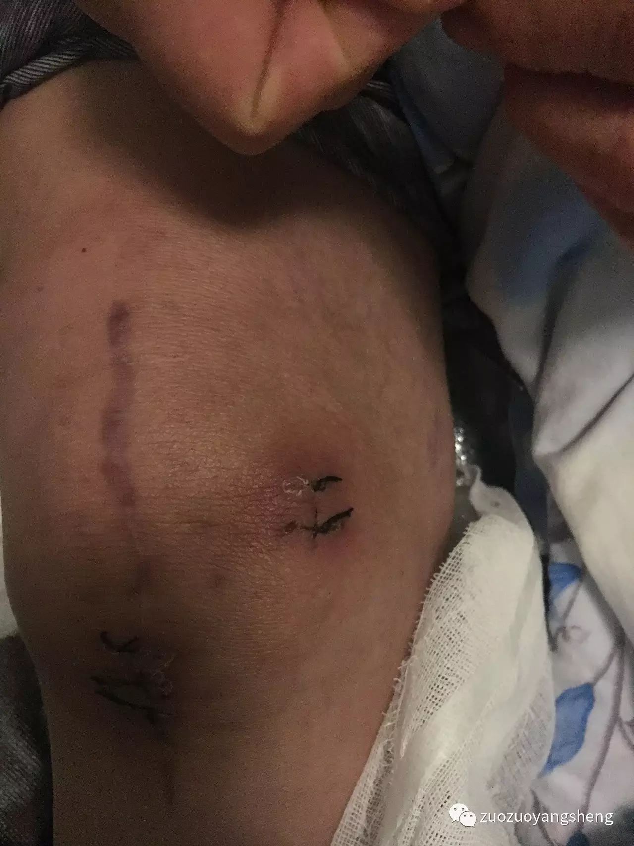 案例分享:最难度的家人——原始点调理妈妈骨折手术后的康复 案例分享:最难度的家人——原始点调理妈妈骨折手术后的康复