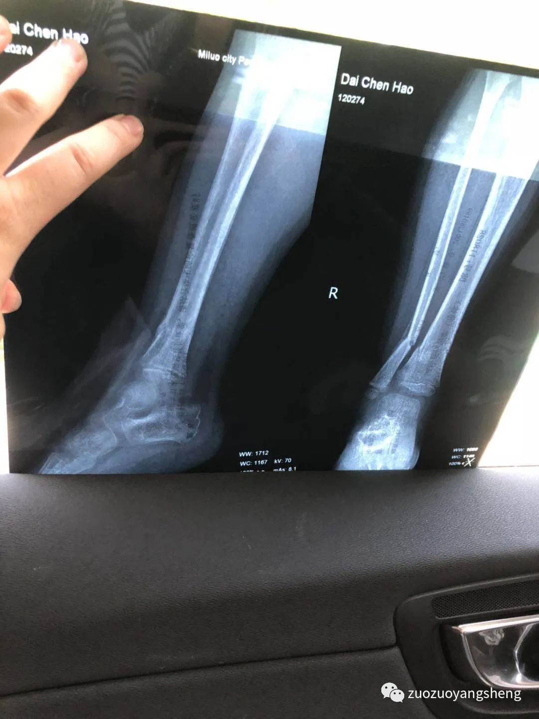 案例分享:原始点调理3岁小孩右腿骨折案例 案例分享:原始点调理3岁小孩右腿骨折案例