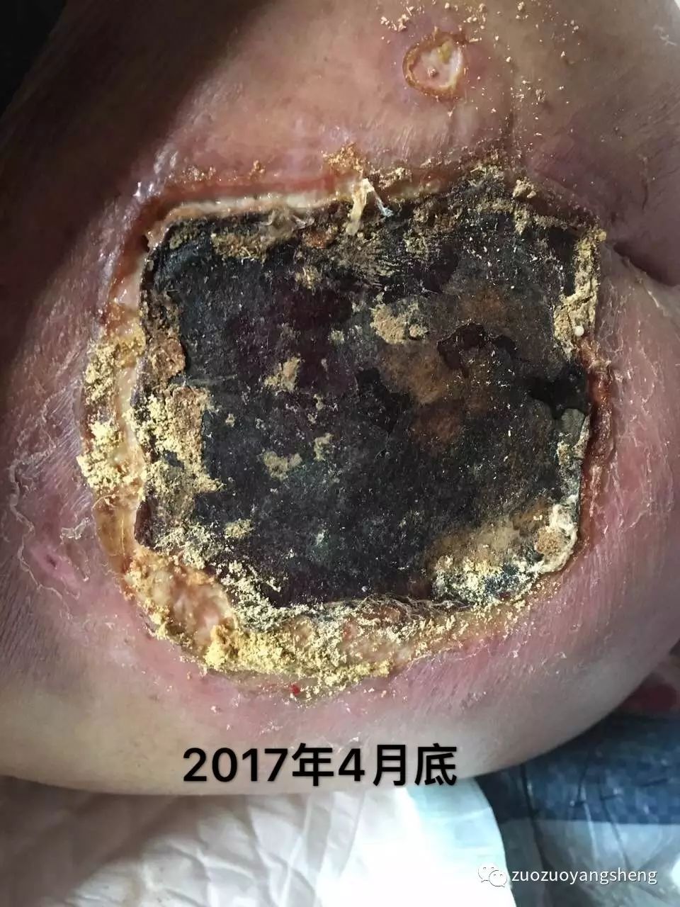 案例分享：原始点调理病危老人的案例