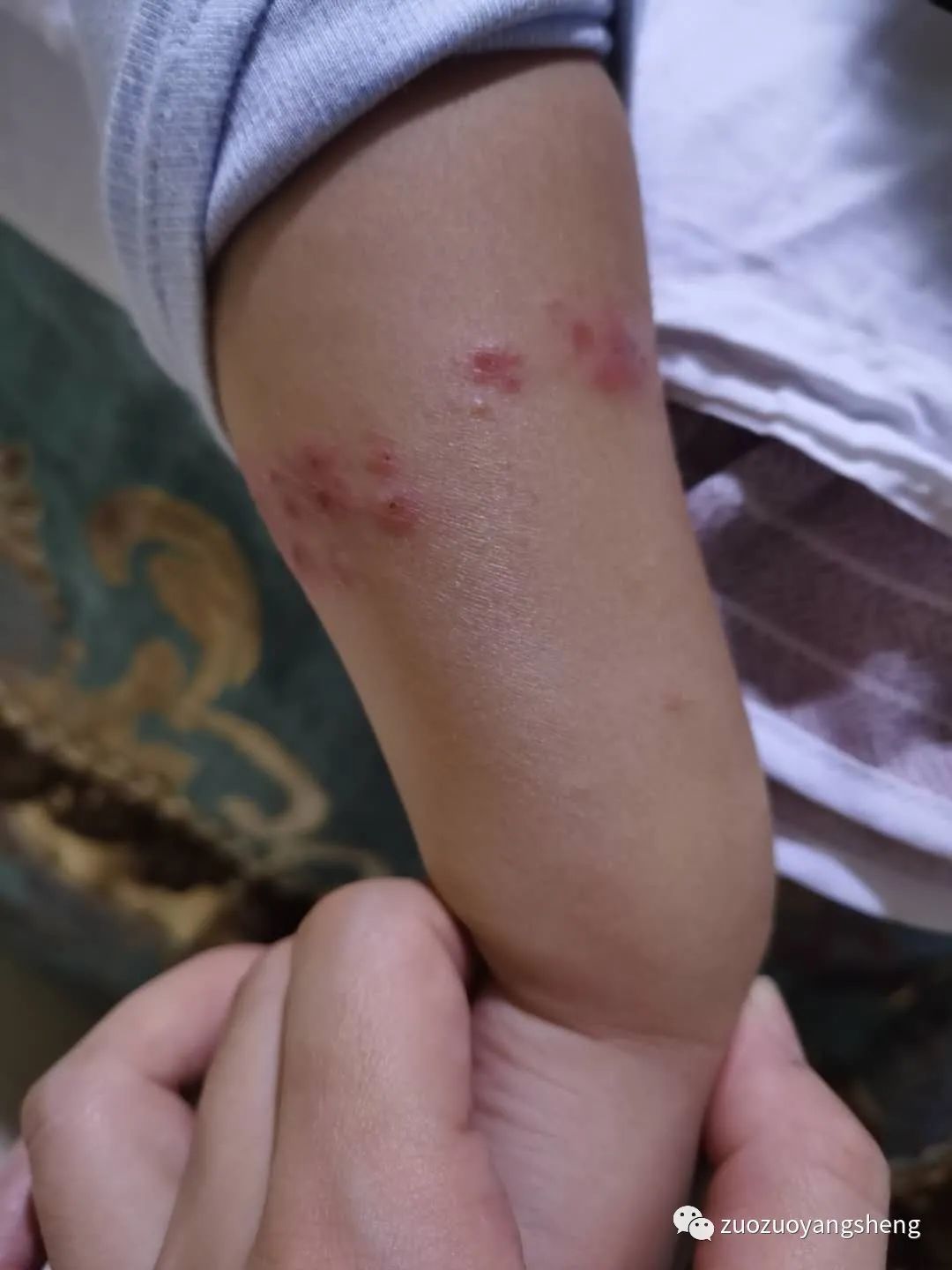 案例分享:原始点调理儿童手足口病的案例 案例分享:原始点调理儿童手足口病的案例