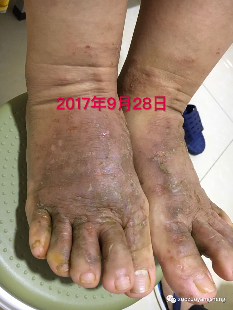 案例分享:原始点调理全身奇痒无比的湿疹案例 案例分享:原始点调理全身奇痒无比的湿疹案例