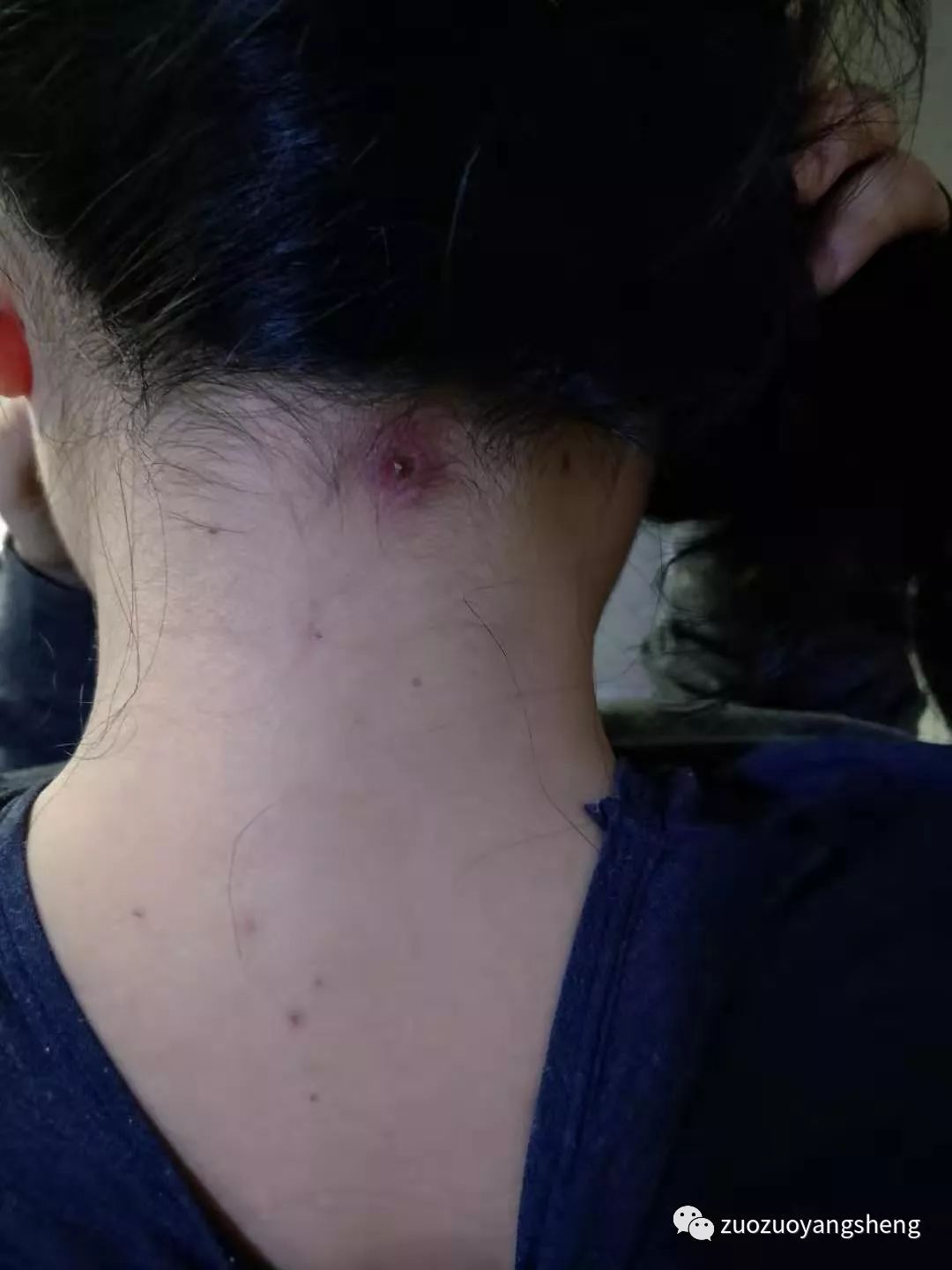 案例分享:原始点调理成人水痘案例 案例分享:原始点调理成人水痘案例