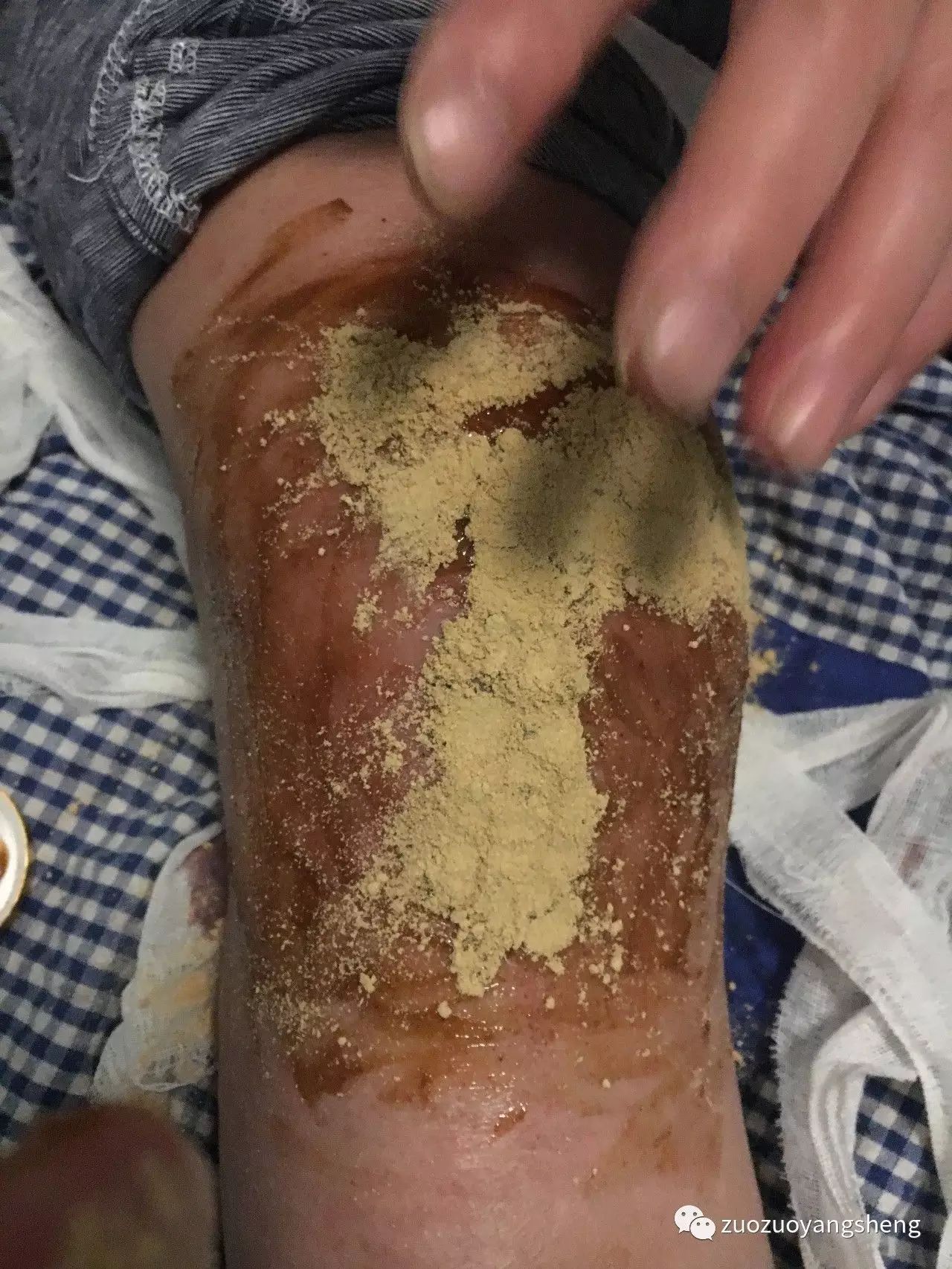 案例分享:最难度的家人——原始点调理妈妈骨折手术后的康复 案例分享:最难度的家人——原始点调理妈妈骨折手术后的康复