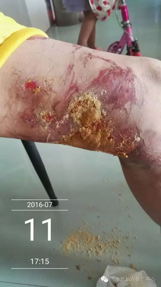 案例分享:原始点调理车祸烧伤不留疤的案例 案例分享:原始点调理车祸烧伤不留疤的案例