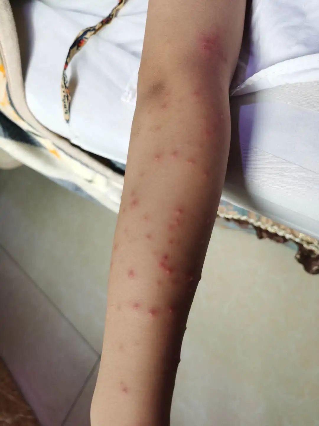 案例分享:原始点调理孩子水痘案例 案例分享:原始点调理孩子水痘案例